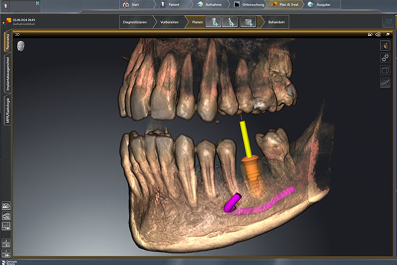 3D-geführte Implantation via Computer